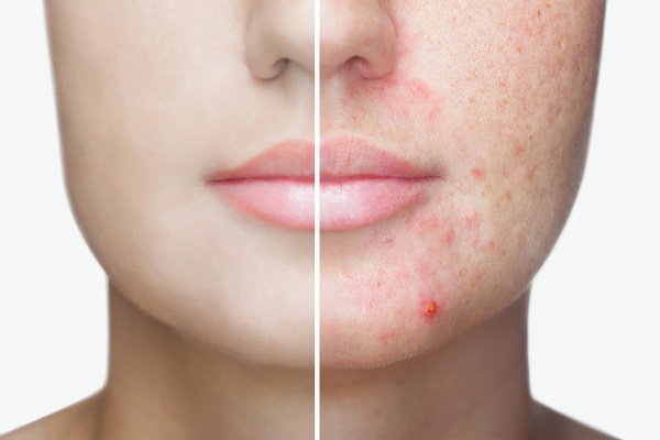 How to Get Rid of Acne Scars: 10 Products and Remedies to Try